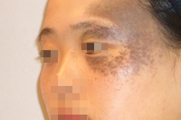 伊藤痣颞部有大面积褐色斑图 伊藤痣颞部有大面积褐色斑图