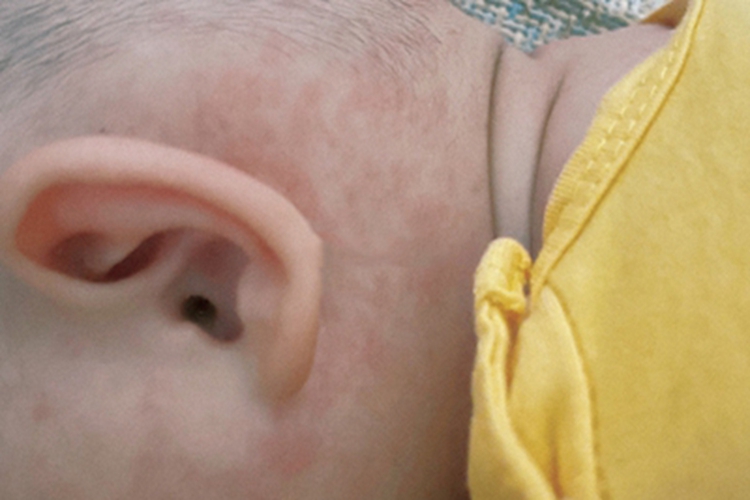 幼儿急疹耳后丘疹图