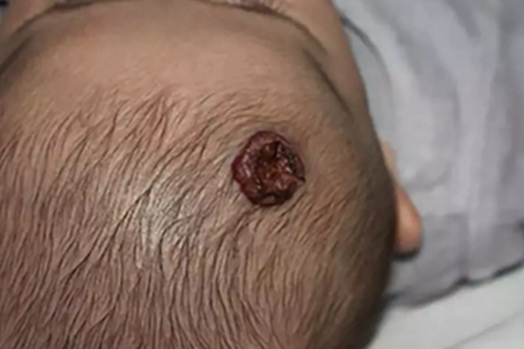 小儿血管瘤头皮溃疡图 小儿血管瘤头皮溃疡图