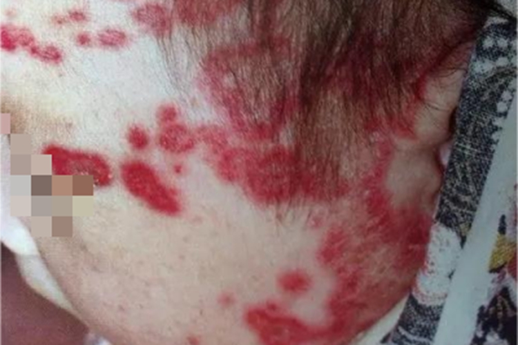 新生儿红斑狼疮面部症状图 新生儿红斑狼疮面部症状图