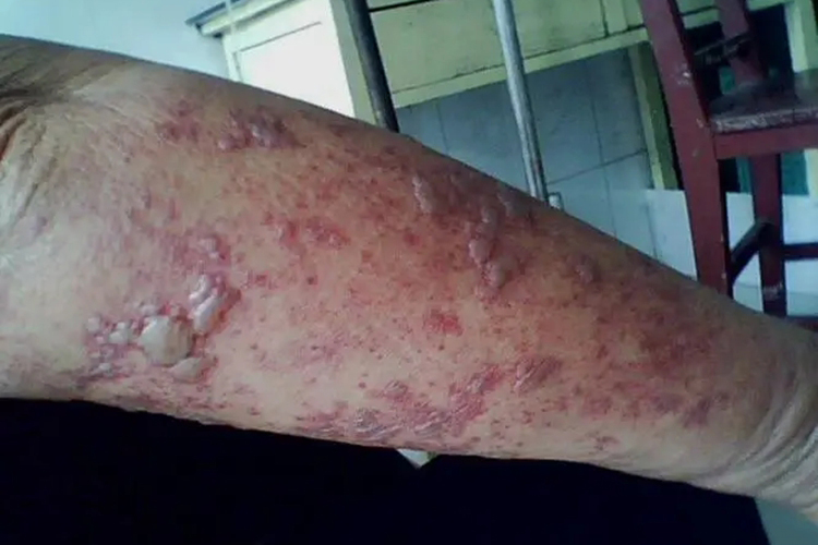艾滋病初期手臂上带状疱疹图
