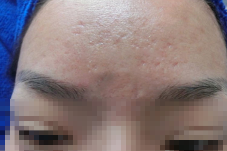 颜面部轻微痘坑图