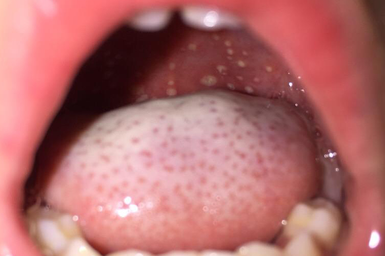 疱疹性咽峡炎疙瘩图 疱疹性咽峡炎疙瘩图