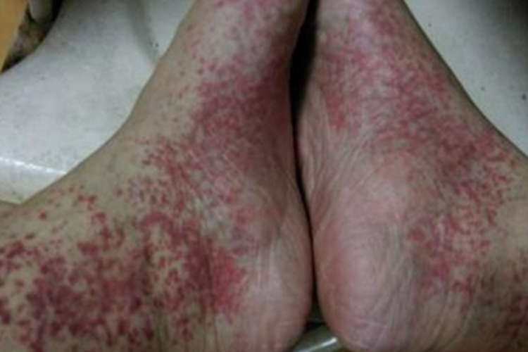 高球蛋白血症性紫癜脚部红点图