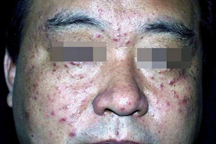 颜面粟粒性狼疮面部症状图 颜面粟粒性狼疮面部症状图