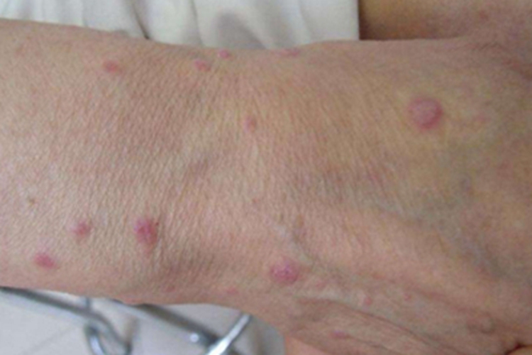 扁平苔藓手腕丘疹图 扁平苔藓手腕丘疹图