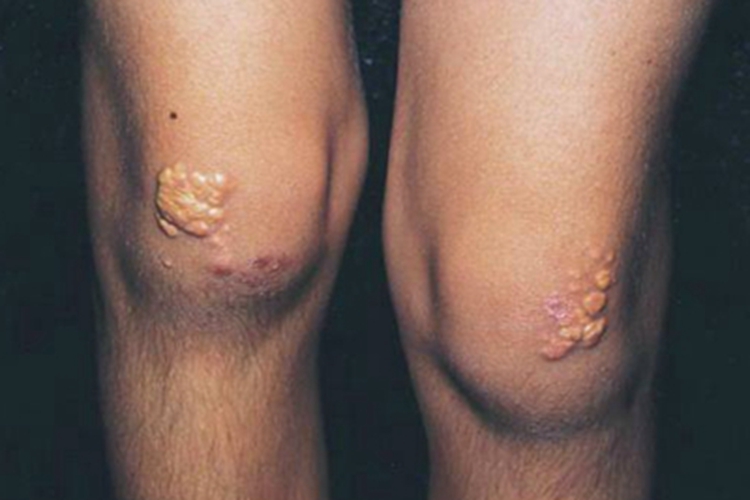 结节性黄瘤膝盖疙瘩图 结节性黄瘤膝盖疙瘩图