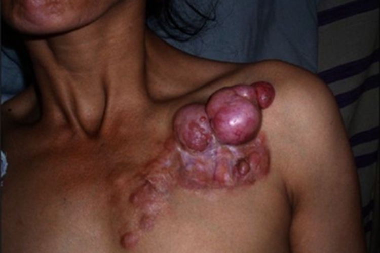 隆突性皮肤纤维肉瘤胸部肉疙瘩图