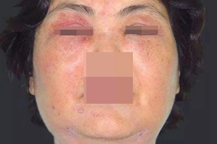 季节性接触性皮炎眼周症状图