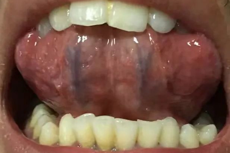 舌底青筋正常图