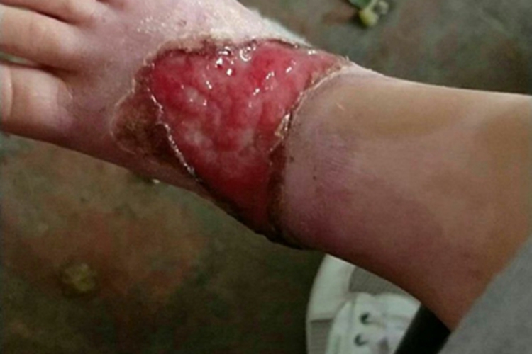 烫伤脚背糜烂图