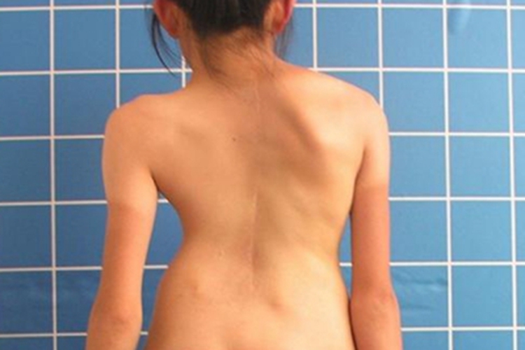 脊柱侧凸背部畸形图