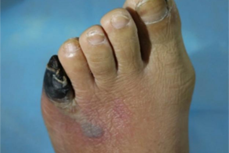 Ⅳ级糖尿病足脚趾皮肤发黑图 Ⅳ级糖尿病足脚趾皮肤发黑图