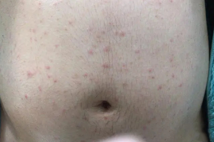 腹部湿疹图