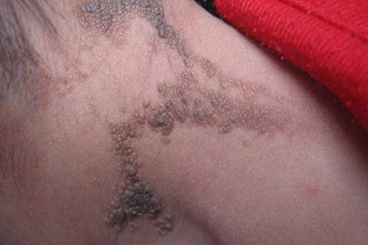 浅表性皮肤脂肪瘤痣颈部症状图