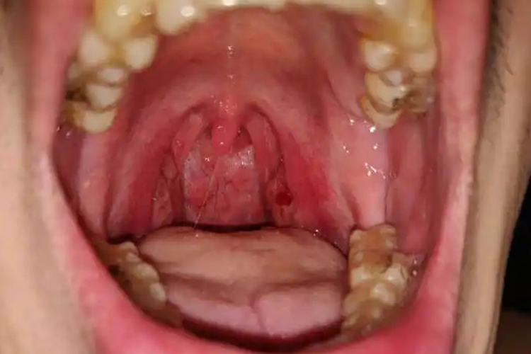 扁桃体切除术后7天出血图