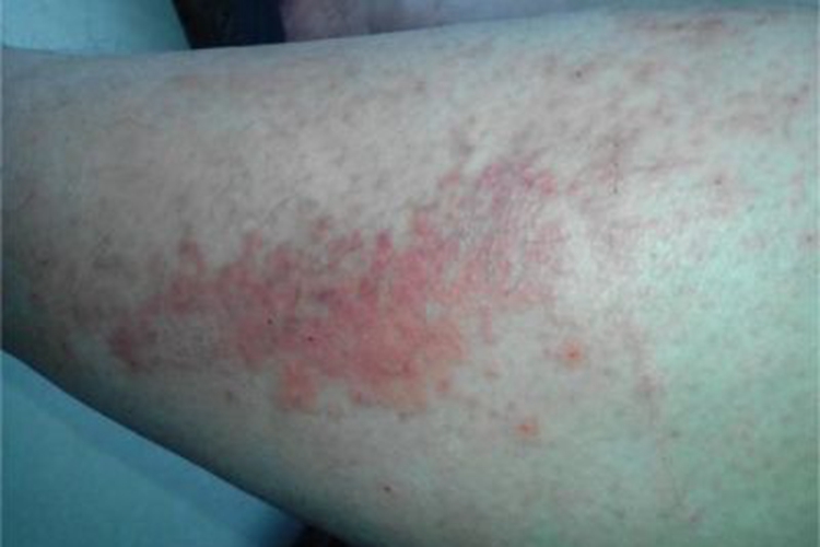 高IgD综合征小腿红斑图