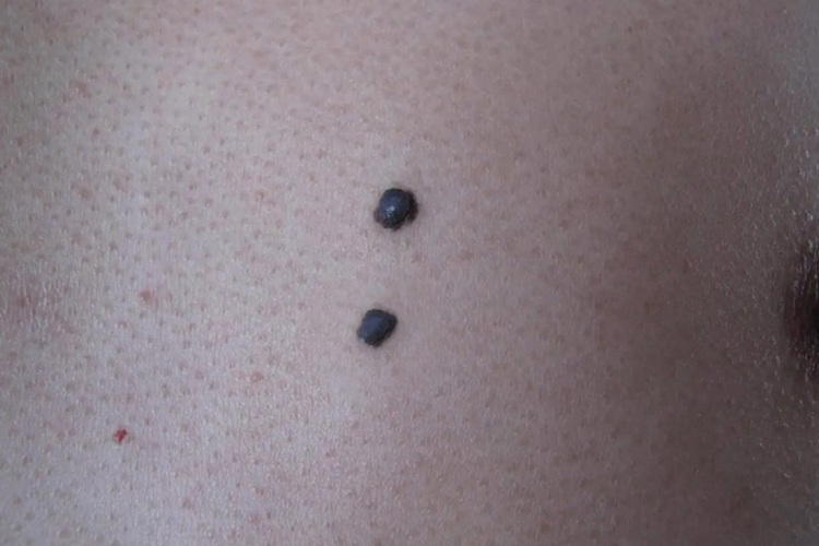 胸口色素痣图 胸口色素痣图