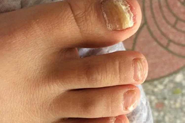 甲营养不良脚趾甲症状图