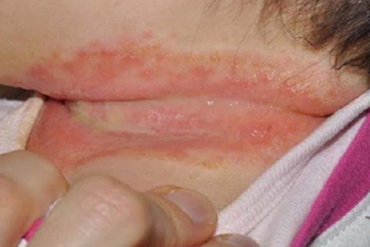 奶癣婴儿脖子起红斑结黄痂图