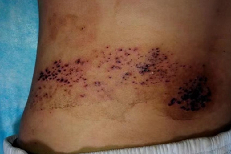 带状疱疹后背结好多黑痂图