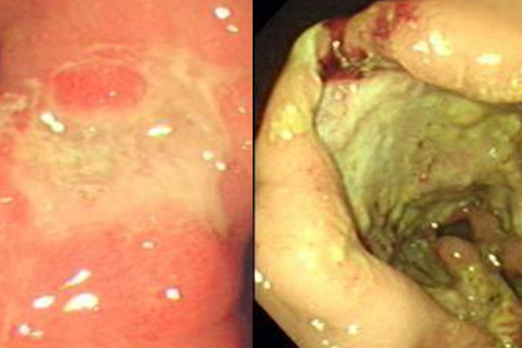大体观早期、晚期胃癌病理图