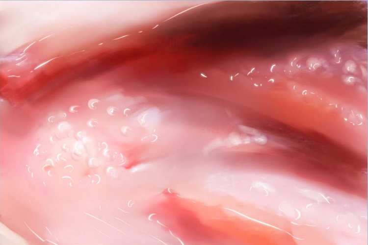 女性生殖器疱疹阴道手绘图