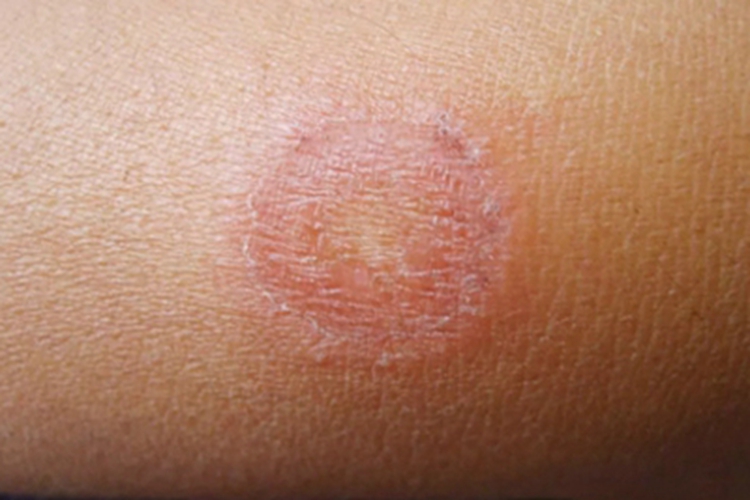 体癣腿部症状图