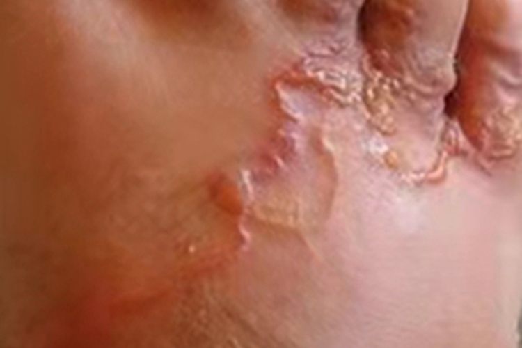 钩虫皮炎脚背水疱图