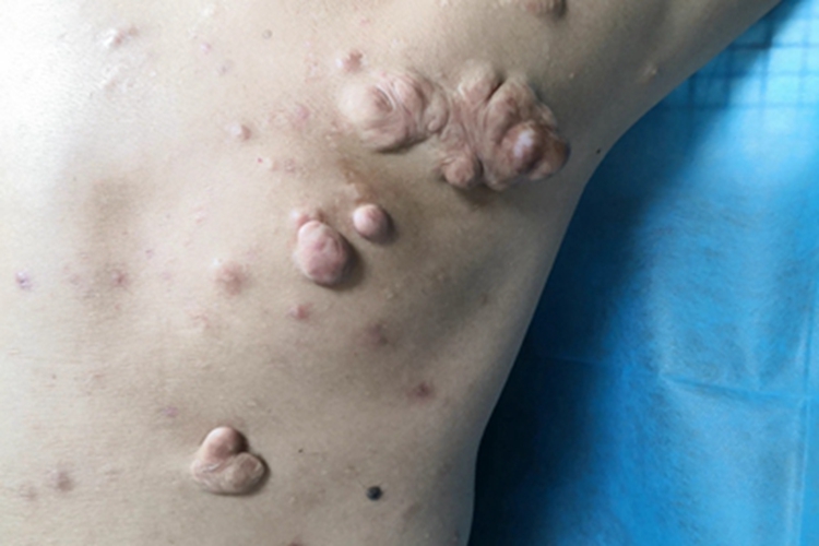 瘢痕疙瘩背部长大疙瘩图