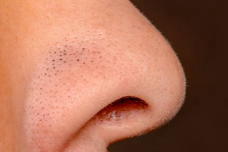 黑头鼻翼上有黑点图