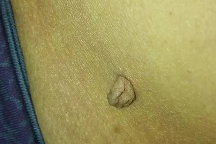 腰部长寻常疣图