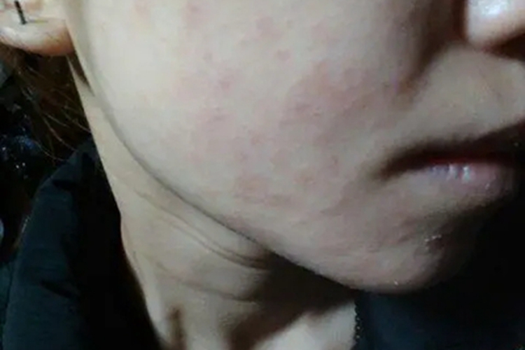 柯萨奇病毒疹症状图