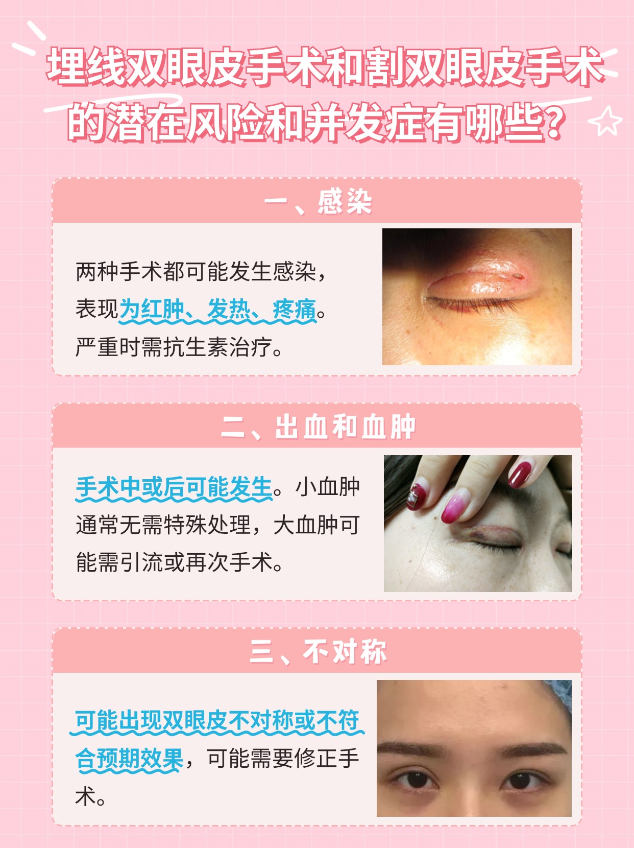 内双埋线or割双眼皮,专家教你如何选择!