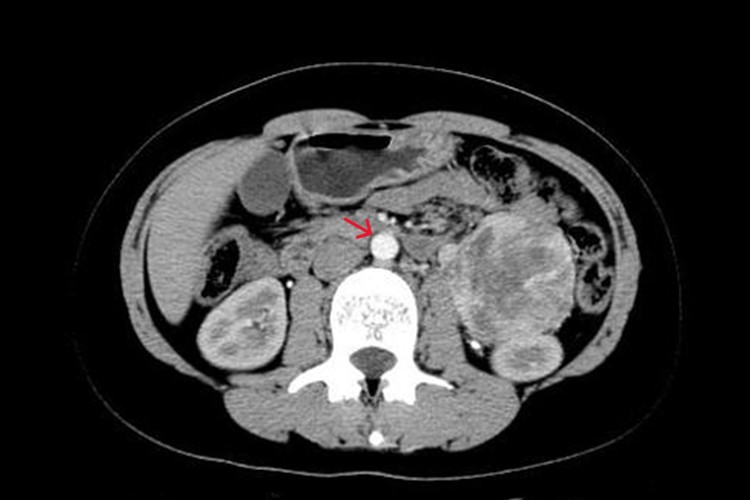 腹膜间皮瘤影像图