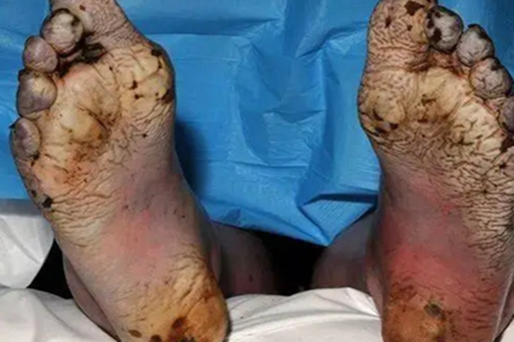 战壕足脚底症状图