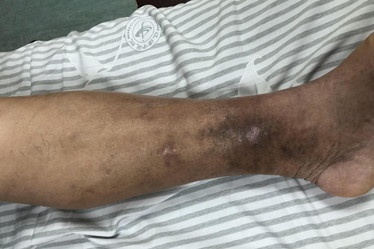 静脉曲张小腿发黑图