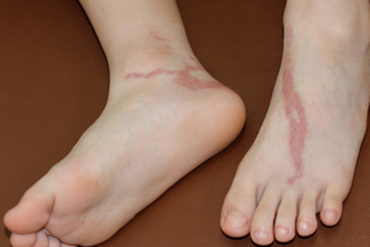 急性淋巴管炎脚背症状图
