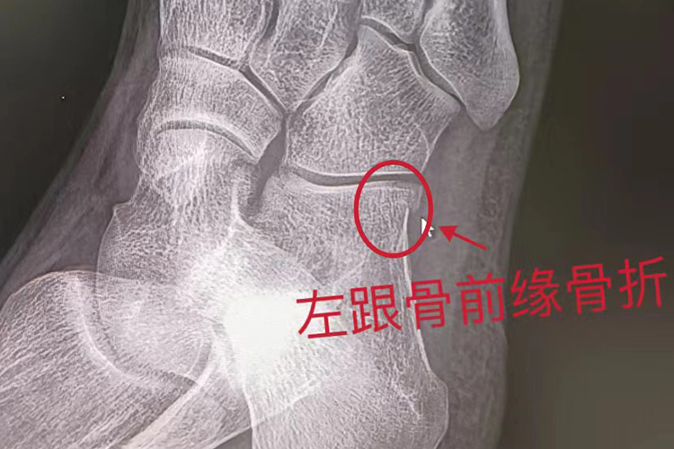 左跟骨前缘骨折图