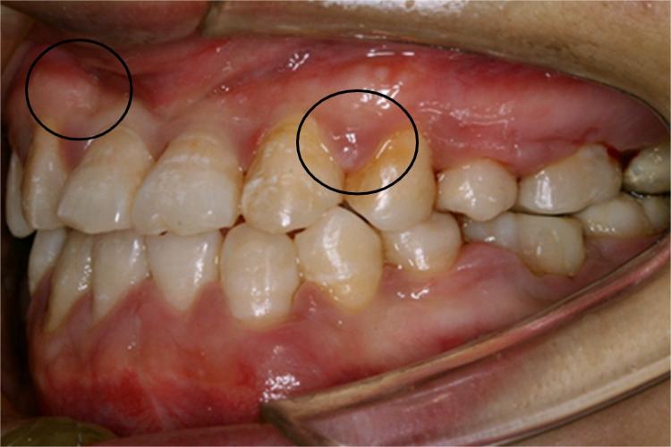 慢性牙周炎牙龈肿图