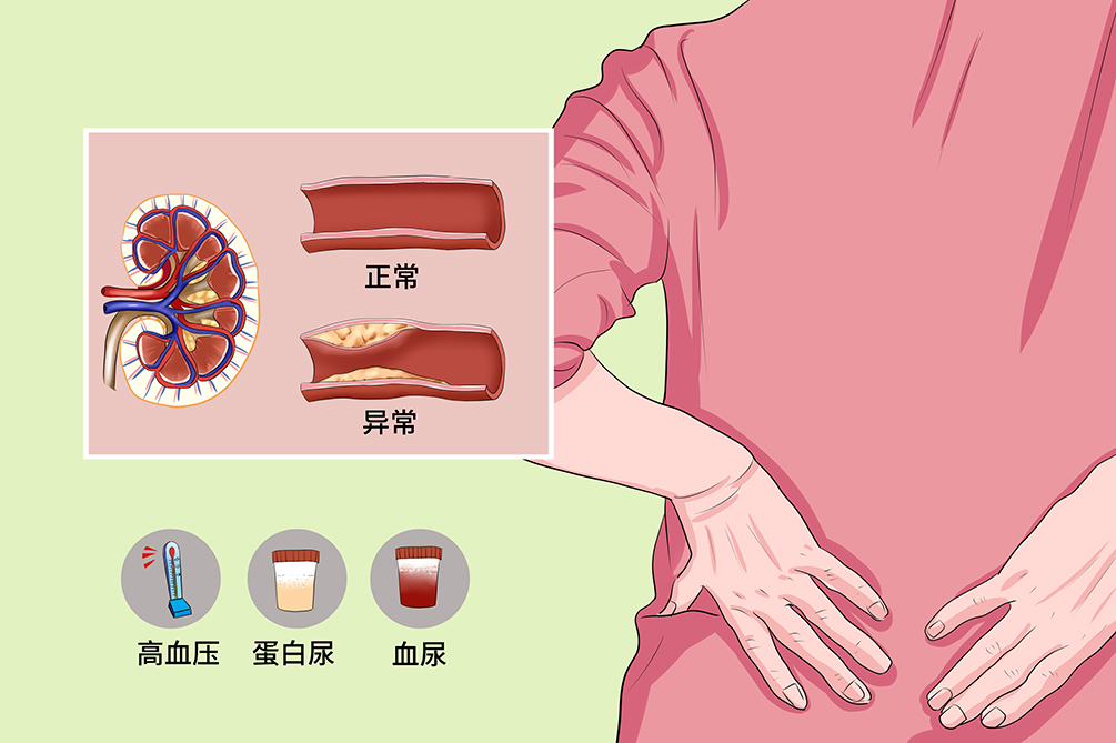 腎動脈狹窄