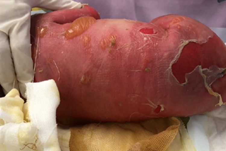 营养不良型大水疱图