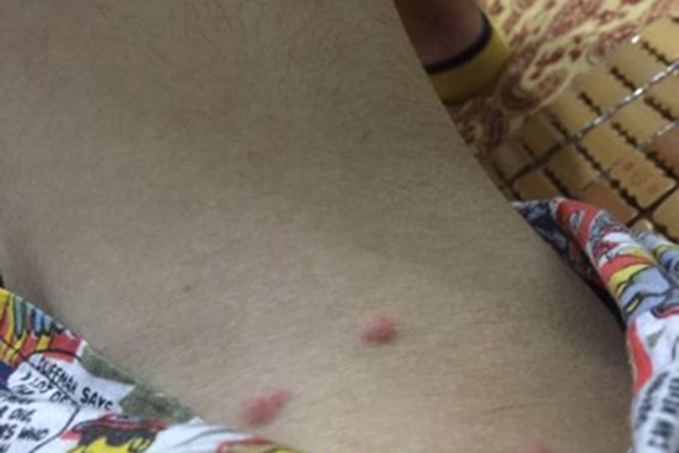 平滑肌瘤症状图