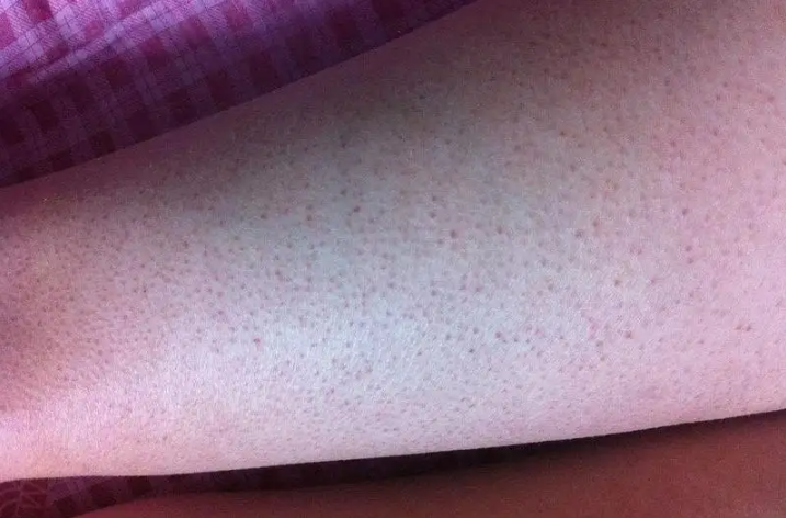 毛周角化病图 毛周角化病图