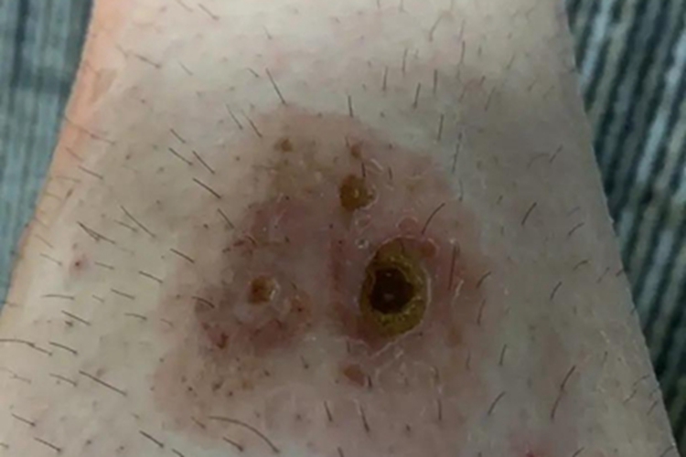 皮肤小血管炎小腿溃疡图