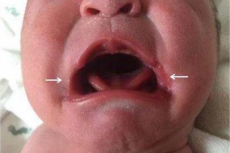 轻度大口畸形嘴唇畸形图