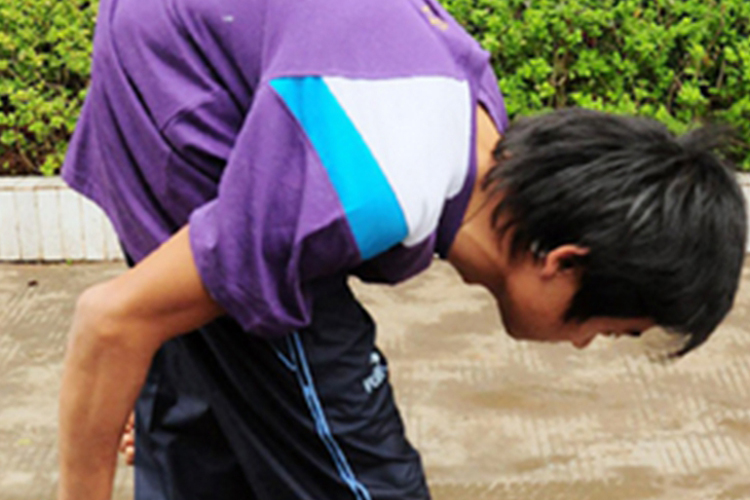 驼背畸形大于70度图