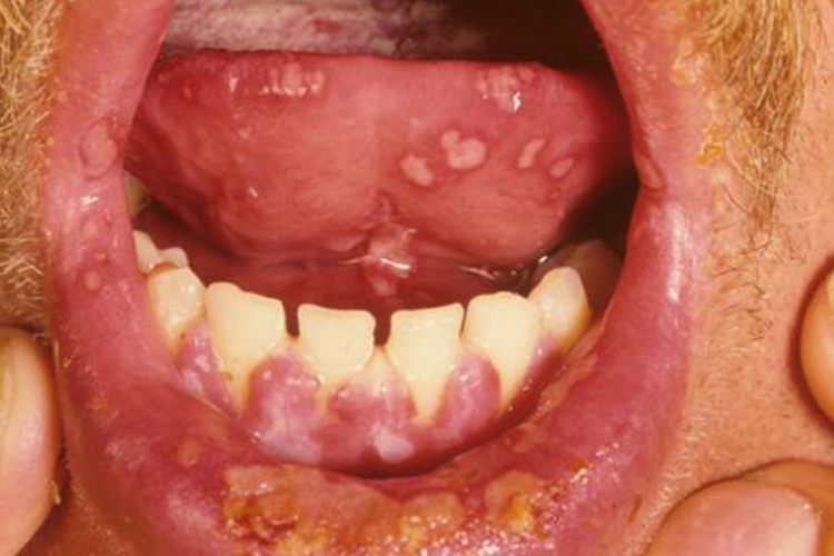 重型口腔溃疡图 重型口腔溃疡图