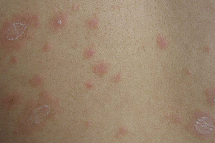 玫瑰色斑丘疹症状图