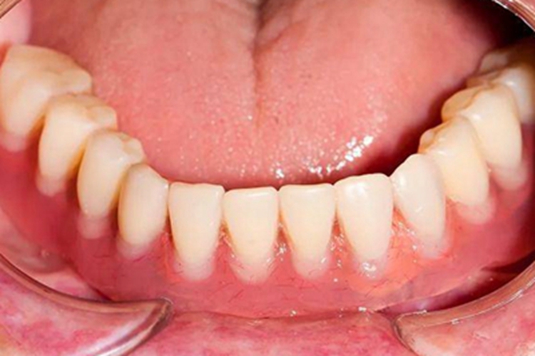 牙龈萎缩牙龈轻微红肿图